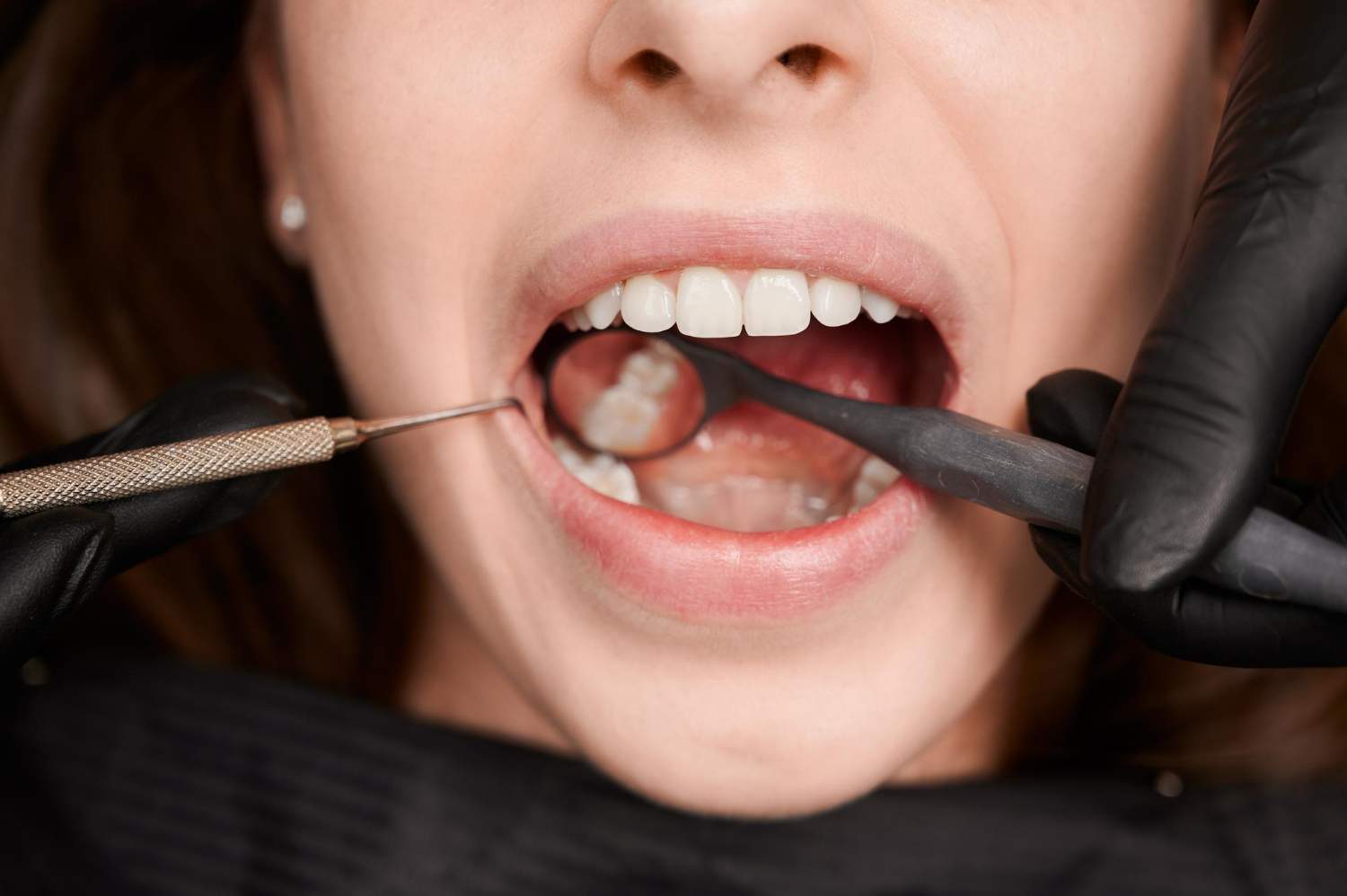 Odontología conservadora en Dorisdent Villaverde