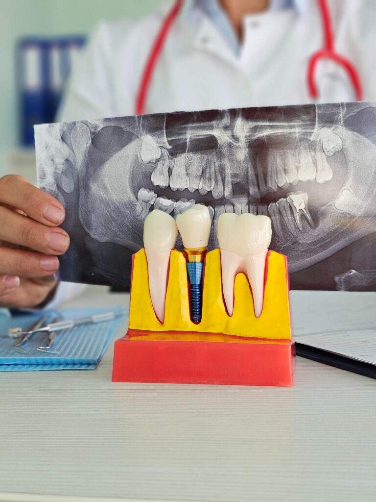 Implantes dentales y cirugía oral en Villaverde
